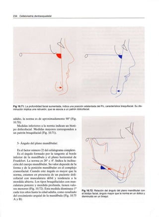 234 Cefalometría dentoesqueletal
O"
Fig 10.71: La profundidad facial aumentada, indica una posición adelantada del Po, característica braquifacial. Su dis-
minución implica una retrusión, que se asocia a un patrón dolicofacial.
adulto, la norma es de aproximadamente 90° (Fig.
10.70).
Medidas inferiores a la norma indican un bioti-
po dolicofacial. Medidas mayores corresponden a
un patrón braquifacial (Fig. 10.71).
5- Ángulo del plano mandibular:
Es el factor número 22 del cefalograma completo.
Es el ángulo formado por la tangente al borde
inferior de la mandíbula y el plano horizontal de
Frankfort. La norma es 26° ± 4°. Indica la inclina-
ción del cuerpo mandibular. Su valor depende de la
forma y de la posición mandibular en el complejo
craneofacial. Cuando este ángulo es mayor que la
norma, estamos en presencia de un paciente doli-
cofacial con musculatura débil y tendencia a la
mordida abierta. Los tipos braquifaciales con mus-
culatura potente y mordida profunda, tienen valo-
res menores (Fig. 10.72). Esta medida disminuye1°
cada tres años hasta la edad adulta, como resultado
del crecimiento arquial de la mandíbula (Fig. 10.75
A y B).
Fig 10.72: Relación del ángulo del plano mandibular con
el biotipo facial, ángulo mayor que la norma en un dolico y
disminuido en un braqui.
 