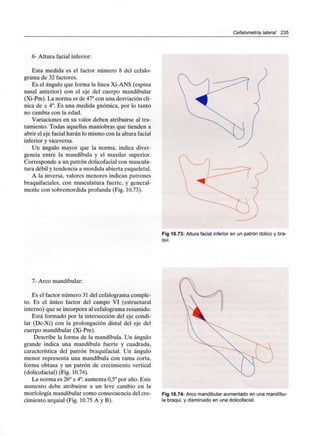 Cefalometría lateral 235
6- Altura facial inferior:
Esta medida es el factor número 8 del cefalo-
grama de 32factores.
Es el ángulo que forma la línea Xi-ANS (espina
nasal anterior) con el eje del cuerpo mandibular
(Xi-Pm). La norma es de 47°con una desviación clí-
nica de ± 4°. Es una medida gnómica, por lo tanto
no cambia con la edad.
Variaciones en su valor deben atribuirse al tra-
tamiento. Todas aquellas maniobras que tienden a
abrir el eje facial harán lo mismo con la altura facial
inferior y viceversa.
Un ángulo mayor que la norma, indica diver-
gencia entre la mandíbula y el maxilar superior.
Corresponde a un patrón dolicofacial con muscula-
tura débil y tendencia a mordida abierta esqueletal.
A la inversa, valores menores indican patrones
braquifaciales, con musculatura fuerte, y general-
mente con sobremordida profunda (Fig. 10.73).
Fig 10.73: Altura facial inferior en un patrón dolico y bra-
qui.
7- Arco mandibular:
Es el factor número 31 del cefalogramacomple-
to. Es el único factor del campo VI (estructural
interno) que se incorpora al cefalogramaresumido.
Está formado por la intersección del eje condi-
lar (Dc-Xi) con la prolongación distal del eje del
cuerpo mandibular (Xi-Pm).
Describe la forma de la mandíbula. Un ángulo
grande indica una mandíbula fuerte y cuadrada,
característica del patrón braquifacial. Un ángulo
menor representa una mandíbula con rama corta,
forma obtusa y un patrón de crecimiento vertical
(dolicofacial) (Fig. 10.74).
La norma es 26°± 4°,aumenta 0,5° por año. Este
aumento debe atribuirse a un leve cambio en la
morfología mandibular como consecuencia del cre-
cimiento arquial (Fig. 10.75 A y B).
Fig 10.74: Arco mandibular aumentado en una mandíbu-
la braqui, y disminuido en una dolicofacial.
 