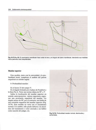 236 Cefalometría dentoesqueletal
Fig 10.75 A y B: El crecimiento mandibular hace variar el arco y el ángulo del plano mandibular, desviando sus medidas
hacia patrones más braquifaciales.
Maxilar superior
Esta medida, junto con la convexidad y la pro-
fundidad facial, completan el análisis del patrón
esqueletal en sentido sagital
8- Profundidad maxilar:
Es el factor 23 del campo V.
Es el ángulo formado por el plano de Frankfort y
la línea Na-A. Tiene una norma clínica de 90°±3°.
Indica la localización del maxilar superior en
sentido anteroposterior, valores superiores expre-
san una protrusión esqueletal del maxilar. Un
ángulo menor de 90°, por el contrario, nos habla de
una retrusión esqueletal del maxilar superior (Fig.
10.76). Esta medida no varía con el crecimiento
normal. Un cambio, sólo puede deberse a la mecá-
nica del tratamiento o estar asociada a un hábito
como succión del pulgar, etc.
Fig 10.76: Profundidad maxilar normal, disminuida y
aumentada.
 