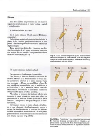 Cefalometría lateral 237
Dientes:
Esta área define las posiciones de los incisivos
superiores e inferiores en el plano vertical, sagital,
y su inclinación.
9- Incisivo inferior a A - Po:
Es el factor número 10 del campo III (dento-
esqueletal).
Es la distancia desde el punto incisivoinferior al
plano A-Po, medida perpendicularmente a este
plano. Describe la posición del incisivo inferior en
el plano sagital
Tiene una norma clínica de + 1mm con una des-
viación estándar de ± 2 mm y permanece constante
con la edad. Es una medida clave para el estudio de
la arcada inferior (Fig 10.77).
D. C. - D. C. +
Fig 10.77: La posición sagital del punto incisivo inferior
define la discrepancia cefalométrica, que será negativa
cuando el incisivo se encuentre por delante de la norma, y
positiva cuando esté por detrás.
Normal Extruido Intruido
10- Incisivo inferior al plano oclusal:
Factor número 5 del campo I, (dentario).
Este factor es llamado también extrusión del
incisivo inferior. Es la distancia entre el borde inci-
sal del incisivo inferior y el plano oclusal. Tiene
una norma de +1,25 mm con una DS de ±2 mm. Es
una medida de suma utilidad para el análisis de la
sobremordida o de la mordida abierta dentaria.
Mediante su observación se determina fácilmente
el responsable de un overbite anormal.
Al evaluar la posición del incisivo inferior con
respecto al plano oclusal, es importante observar
previamente la posición de este plano en su parte
anterior. Debe pasar 3 mm por debajo de la comi-
sura labial.
En los casos en que el plano oclusal esté ubica-
do a una distancia significativamente mayor o
menor, la planificación de la posición del incisivo
inferior requerirá la "normalización" de este plano
para armonizar la relación de los dientes anteriores
con el labio superior (Fig. 10.78).
Fig 10.78 A: Posición del 1 con respecto al plano oclusal
B: Incisivos ubicados correctamente en relación a un
plano oclusal bajo (aumento de la distancia plano oclusal -
comisura labial) tienen un exceso de exposición del incisi-
vo superior.
 