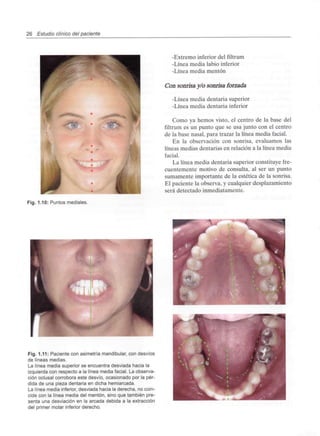 26 Estudio clínico del paciente
-Extremo inferior del filtrum
-Línea media labio inferior
-Línea media mentón
Con sonrisa y/o sonrisa forzada
-Línea media dentaria superior
-Línea media dentaria inferior
Como ya hemos visto, el centro de la base del
filtrum es un punto que se usa junto con el centro
de la base nasal, para trazar la línea media facial.
En la observación con sonrisa, evaluamos las
líneas medias dentarias en relación a la línea media
facial.
La línea media dentaria superior constituye fre-
cuentemente motivo de consulta, al ser un punto
sumamente importante de la estética de la sonrisa.
El paciente la observa, y cualquier desplazamiento
será detectado inmediatamente.
Fig. 1.10: Puntos mediales.
Fig. 1.11: Paciente con asimetría mandibular, con desvíos
de líneas medias.
La línea media superior se encuentra desviada hacia la
izquierda con respecto a la línea media facial. La observa-
ción oclusal corrobora este desvío, ocasionado por la pér-
dida de una pieza dentaria en dicha hemiarcada.
La línea media inferior, desviada hacia la derecha, no coin-
cide con la línea media del mentón, sino que también pre-
senta una desviación en la arcada debida a la extracción
del primer molar inferior derecho.
 