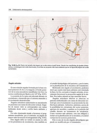 246 Cefalometría dentoesqueleta!
B
Fig. 10.90 A y B: Efecto del tamaño del ángulo de la silla sobre el perfil facial. Siendo las mandíbulas de iguales dimen-
siones, en A (ángulo de la silla disminuido), la sínfisis se proyecta más hacia adelante que en la figura B (ángulo de la silla
aumentado).
Ángulo articular:
Es una relación angular formada por la base cra-
neal posterior (S-Ar) y la tangente al borde poste-
rior de la rama ascendente mandibular (Ar-Go). La
norma establecida por Bjork es de 143° (Fig. 10.91).
La posición de la rama está afectada durante su
crecimiento y desarrollo por el entorno muscular y
el crecimiento dentoalveolar.
Ángulos articulares aumentados se encontrarán
en pacientes con ramas de dirección vertical.Ángu-
los de menor valor se corresponden con ramas
inclinadas desde atrás y arriba hacia adelante y
abajo.
Un valor disminuido tiende a favorecer el prog-
natismo mandibular, por el contrario, un ángulo de
mayor valor favorecerá el retrognatismo (Fig. 10.92).
Este ángulo debe ser tenido en cuenta no sólo
en los pronósticos de crecimiento, sino también en
el estudio biotipológico del pacientey, por lo tanto,
en la planificación de la mecánica del tratamiento.
Refiriendo este ángulo al crecimiento, podemos
decir que cuanto más hacia adelante esté orientada
la línea Ar-Go, cerrando el ángulo articular, el cre-
cimiento favorecerá la proyección sagital de la sín-
fisis. Nos indica además un tipo muscular fuerte.
Ángulos articulares abiertos se observan en
patrones dolicofaciales con ramas de dirección ver-
tical que con el crecimiento no proyectarán las sín-
fisis hacia adelante. Advierten, asimismo, acerca de
la posibilidad de extrusiones del sector posterior,
apertura de mordida y cambios en la posición del
cóndilo durante un tratamiento de ortodoncia.
Como veremos más adelante, esto nos obligará a
incluir en la planificaciónde la mecánica, el control
vertical de los sectores posteriores.
Éste es uno de los dos ángulos del polígono que
puede ser modificado por el tratamiento.
 
