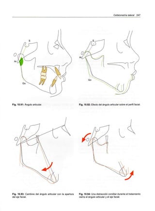 Cefalometría lateral 247
Go
Fig. 10.91: Ángulo articular. Fig. 10.92: Efecto del ángulo articular sobre el perfil facial.
Fig. 10.93: Cambios del ángulo articular con la apertura
del eje facial.
Fig. 10.94: Una distracción condilar durante el tratamiento
cierra el ángulo articular y el eje facial.
 
