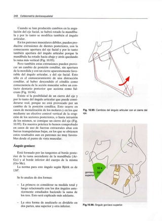 248 Cefalometría dentoesqueletal
Cuando se han producido cambios en la angu-
lación del eje facial, se habrá rotado la mandíbu-
la y por lo tanto se modifica también el ángulo
articular.
En los patrones musculares débiles, pueden pro-
ducirse extrusiones de dientes posteriores, con la
consecuente apertura del eje facial y por lo tanto
también apertura del ángulo articular porque la
mandíbula ha rotado hacia abajo y atrás quedando
la rama más vertical (Fig. 10.93).
Pero también estas extrusiones pueden provo-
car un cambio de posición condilar, sin apertura
de la mordida y con un cierre aparentemente favo-
rable del ángulo articular, y del eje facial. Esto
sólo es el enmascaramiento de una distracción
condilar, al haber descendido el cóndilo como
consecuencia de la acción muscular sobre un con-
tacto dentario posterior que acciona como ful-
crum (Fig. 10.94).
Existe sí la posibilidad de un cierre del eje y
por lo tanto del ángulo articular que puede consi-
derarse real, porque no está provocado por un
cambio de la posición condílea. Esto ocurre en
casos de mesialización de los molares y en los que
mediante un efectivo control vertical de la erup-
ción de los sectores posteriores, o hasta intrusión
de los mismos, se consigue un cierre del eje (Fig.
10.95). En nuestra práctica lo hemos comprobado
en casos de uso de fuerzas extraorales altas con
barras transpalatinas bajas, en los que se obtienen
estos resultados aun en patrones no muy favora-
bles desde el punto de vista muscular.
Ángulo goníaco:
Está formado por las tangentes al borde poste-
rior de la rama ascendente de la mandíbula (Ar-
Go) y al borde inferior del cuerpo de la misma
(Go-Me).
La norma para este ángulo según Bjórk es de
130°.
Se lo analiza de dos formas:
- La primera es considerar su medida total y
luego relacionarlo con los dos ángulos ante-
riormente estudiados haciendo la suma de
los tres. Esto será explicado más adelante.
- La otra forma de analizarlo es dividirlo en
dos partes, una superior y otra inferior.
Fig. 10.95: Cambios del ángulo articular con el cierre del
eje.
goníaco 55°
superior,
Fig.10.96: Ángulo goníaco superior.
 