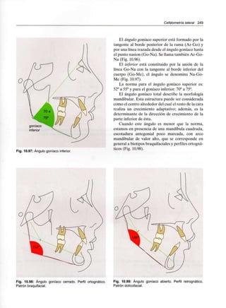 Cefalometría lateral 249
goniaco
inferior
Fig. 10.97: Ángulo goníaco inferior.
El ángulo goníaco superior está formado por la
tangente al borde posterior de la rama (Ar-Go) y
por una línea trazada desde el ángulo goníaco hasta
el punto nasion (Go-Na). Se llama también Ar-Go-
Na (Fig. 10.96).
El inferior está constituido por la unión de la
línea Go-Na con la tangente al borde inferior del
cuerpo (Go-Me), el ángulo se denomina Na-Go-
Me (Fig. 10.97).
La norma para el ángulo goníaco superior es:
52° a 55° y para el goníaco inferior: 70° a 75°.
El ángulo goníaco total describe la morfología
mandibular. Esta estructura puede ser considerada
como el centro alrededor del cual el resto de la cara
realiza un crecimiento adaptativo; además, es la
determinante de la dirección de crecimiento de la
parte inferior de ésta.
Cuando este ángulo es menor que la norma,
estamos en presencia de una mandíbula cuadrada,
escotadura antegonial poco marcada, con arco
mandibular de valor alto, que se corresponde en
general a biotipos braquifaciales y perfiles ortogná-
ticos (Fig. 10.98).
Fig. 10.98: Ángulo goníaco cerrado. Perfil ortognático.
Patrón braquifacial.
Fig. 10.99: Ángulo goníaco abierto. Perfil retrognático.
Patrón dolicofacial.
 