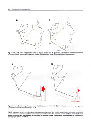 250 Cefalometría dentoesqueletal
B
126 126
Fig. 10.100 A y B: Estos dos pacientes tienen un ángulo goníaco total de igual valor. Obsérvese la diferente implantación
de las mandíbulas, y cómo esto determina valores diferentes de la mitad superior e inferior de este ángulo.
Fig. 10.101 A y B: Mitad superior aumentada (A). Mitad superior disminuida (B). Con el crecimiento en A hay mayor pro-
yección del mentón hacia adelante que en B.
NOTA: Las figuras 10.101 a 10.106 no pertenecen a calcos radiográficos. Son diseños realizados con la finalidad de facilitar la
comprensión. Se confeccionaron haciendo variar los valores de los ángulos goníacos superior e inferior manteniendo cons-
tante la inclinación de la línea Go-Na en las figuras que se comparan entre sí, y adicionando módulos iguales de crecimiento en
el cuerpo y en la rama mandibular.
 
