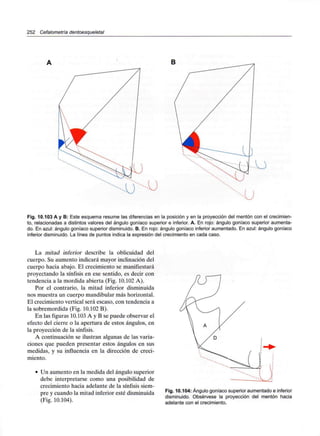 252 Cefalometría dentoesqueletal
Fig. 10.103 A y B: Este esquema resume las diferencias en la posición y en la proyección del mentón con el crecimien-
to, relacionadas a distintos valores del ángulo goníaco superior e inferior. A. En rojo: ángulo goníaco superior aumenta-
do. En azul: ángulo goníaco superior disminuido. B. En rojo: ángulo goníaco inferior aumentado. En azul: ángulo goníaco
inferior disminuido. La línea de puntos indica la expresión del crecimiento en cada caso.
La mitad inferior describe la oblicuidad del
cuerpo. Su aumento indicará mayor inclinación del
cuerpo hacia abajo. El crecimiento se manifiestará
proyectando la sínfisis en ese sentido, es decir con
tendencia a la mordida abierta (Fig. 10.102 A).
Por el contrario, la mitad inferior disminuida
nos muestra un cuerpo mandibular más horizontal.
El crecimiento vertical será escaso, con tendencia a
la sobremordida (Fig. 10.102 B).
En las figuras 10.103 A y B se puede observar el
efecto del cierre o la apertura de estos ángulos, en
la proyección de la sínfisis.
A continuación se ilustran algunas de las varia-
ciones que pueden presentar estos ángulos en sus
medidas, y su influencia en la dirección de creci-
miento.
• Un aumento en la medida del ángulo superior
debe interpretarse como una posibilidad de
crecimiento hacia adelante de la sínfisis siem-
pre y cuando la mitad inferior esté disminuida
(Fig. 10.104).
Fig. 10.104: Ángulo goníaco superior aumentado e inferior
disminuido. Obsérvese la proyección del mentón hacia
adelante con el crecimiento.
 