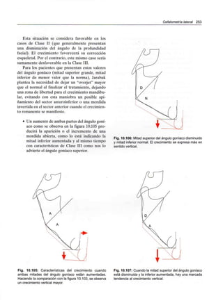 Cefalometría lateral 253
Esta situación se considera favorable en los
casos de Clase II (que generalmente presentan
una disminución del ángulo de la profundidad
facial). El crecimiento favorecerá su corrección
esqueletal. Por el contrario, este mismo caso sería
sumamente desfavorable en la Clase III.
Para los pacientes que presentan estos valores
del ángulo goníaco (mitad superior grande, mitad
inferior de menor valor que la norma), Jarabak
plantea la necesidad de dejar un "overjet" mayor
que el normal al finalizar el tratamiento, dejando
una zona de libertad para el crecimiento mandibu-
lar, evitando con esta maniobra un posible api-
ñamiento del sector anteroinferior o una mordida
invertida en el sector anterior cuando el crecimien-
to remanente se manifieste.
• Un aumento de ambas partes del ángulo goní-
aco como se observa en la figura 10.105 pro-
ducirá la aparición o el incremento de una
mordida abierta, como lo está indicando la
mitad inferior aumentada y al mismo tiempo
con características de Clase III como nos lo
advierte el ángulo goníaco superior.
Fig. 10.106: Mitad superior del ángulo goníaco disminuido
y mitad inferior normal. El crecimiento se expresa más en
sentido vertical.
Fig. 10.105: Características del crecimiento cuando
ambas mitades del ángulo goníaco están aumentadas.
Haciendo la comparación con la figura 10.103, se observa
un crecimiento vertical mayor.
Fig. 10.107: Cuando la mitad superior del ángulo goníaco
está disminuida y la inferior aumentada, hay una marcada
tendencia al crecimiento vertical.
 