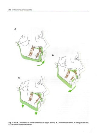 260 Cefalometría dentoesqueletal
B
Fig. 10.114: A. Crecimiento en sentido contrario a las agujas del reloj. B. Crecimiento en sentido de las agujas del reloj.
C. Crecimiento directo hacia abajo.
 