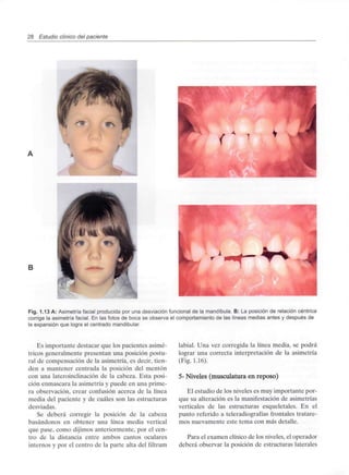 28 Estudio clínico del paciente
'
B
Fig. 1.13 A: Asimetríafacial producida por una desviaciónfuncional de la mandíbula. B: La posición de relacióncéntrica
corrige la asimetríafacial. En las fotos de boca se observa el comportamientode las líneas medias antes y después de
la expansión que logra el centradomandibular.
Es importante destacar que los pacientes asimé-
tricos generalmente presentan una posición postu-
ral de compensación de la asimetría, es decir, tien-
den a mantener centrada la posición del mentón
con una lateroinclinación de la cabeza. Esta posi-
ción enmascara la asimetría y puede en una prime-
ra observación, crear confusión acerca de la línea
media del paciente y de cuáles son las estructuras
desviadas.
Se deberá corregir la posición de la cabeza
basándonos en obtener una línea media vertical
que pase, como dijimos anteriormente, por el cen-
tro de la distancia entre ambos cantos oculares
internos y por el centro de la parte alta del filtrum
labial. Una vez corregida la línea media, se podrá
lograr una correcta interpretación de la asimetría
(Fig. 1.16).
5- Niveles (musculatura en reposo)
El estudio de los niveles es muy importante por-
que su alteración es la manifestación de asimetrías
verticales de las estructuras esqueletales. En el
punto referido a teleradiografías frontales tratare-
mos nuevamente este tema con más detalle.
Para el examen clínico de los niveles, el operador
deberá observar la posición de estructuras laterales
 