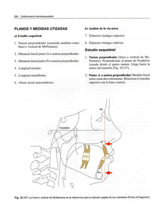 268 Cefalometría dentoesqueletal
PLANOS Y MEDIDAS UTIZADAS
a) Estudio esqueletal
1. Nasion perpendicular (conocida también como
línea o vertical de McNamara).
2. Distancia lineal punto A a nasion perpendicular.
3. Distancia lineal punto Po a nasion perpendicular.
4. Longitud maxilar.
5. Longitud mandibular.
6. Altura facial anteroinferior.
b) Análisis de la vía aérea
7. Diámetro faríngeo superior.
8. Diámetro faríngeo inferior.
Estudioesqueletal
1. Nasion perpendicular (línea o vertical de Mc-
Namara): Perpendicular al plano de Frankfort
trazada desde el punto nasion. Llega hasta la
altura del mentón (Fig. 10.117).
2. Punto A a nasion perpendicular:Medida lineal
entre estas dos referencias. Relaciona el maxilar
superior con la base craneal.
Fig. 10.117: La línea o vertical de McNamara es la referencia para el estudio sagital de los maxilares (Punto A-Pogonion).
 