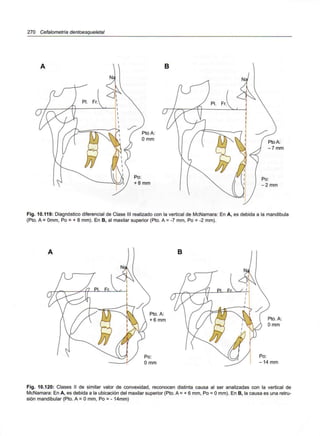 270 Cefalometría dentoesque/etal
Pto A:
O mm
Pto A:
-7 mm
Fig. 10.119: Diagnóstico diferencial de Clase III realizado con la vertical de McNamara: En A, es debida a la mandíbula
(Pto. A = Omm,Po = + 8 mm). En B, al maxilar superior (Pto. A = -7 mm, Po = -2 mm).
Pto. A:
+ 6 mm Pto. A:
O mm
Po:
-14mm
Fig. 10.120: Clases II de similar valor de convexidad, reconocen distinta causa al ser analizadas con la vertical de
McNamara: En A, es debida a la ubicación del maxilar superior (Pto. A = + 6 mm, Po = Omm). En B, la causa es una retru-
sión mandibular (Pto. A = Omm, Po = - 14mm)
 