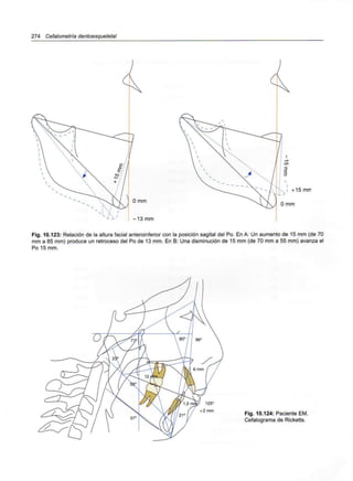 274 Cefalometría dentoesqueletal
Fig. 10.123: Relación de la altura facial anteroinferior con la posición sagital del Po. En A: Un aumento de 15 mm (de 70
mm a 85 mm) produce un retroceso del Po de 13 mm. En B: Una disminución de 15 mm (de 70 mm a 55 mm) avanza el
Po 15 mm.
Fig. 10.124: Paciente EM.
Cefalograma de Ricketts.
 