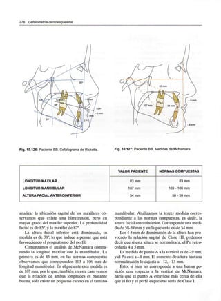 276 Cefalometría dentoesqueletal
-8mm
Fig. 10.126: Paciente BB. Cefalograma de Ricketts. Fig. 10.127: Paciente BB. Medidas de McNamara.
LONGITUD MAXILAR
LONGITUD MANDIBULAR
ALTURA FACIAL ANTEROINFERIOR
VALOR PACIENTE
83 mm
107 mm
54 mm
NORMAS COMPUESTAS
83 mm
103 - 106 mm
58 - 59 mm
analizar la ubicación sagital de los maxilares ob-
servamos que existe una birretrusión, pero en
mayor grado del maxilar superior. La profundidad
facial es de 85°, y la maxilar de 82°.
La altura facial inferior está disminuida, su
medida es de 38°, lo que induce a pensar que está
favoreciendo el prognatismo del perfil.
Comenzamos el análisis de McNamara compa-
rando la longitud maxilar con la mandibular. La
primera es de 83 mm, en las normas compuestas
observamos que corresponden 103 a 106 mm de
longitud mandibular. En el paciente esta medida es
de 107mm, por lo que, también en este caso vemos
que la relación de ambas longitudes es bastante
buena, sólo existe un pequeño exceso en el tamaño
mandibular. Analizamos la tercer medida corres-
pondiente a las normas compuestas, es decir, la
altura facial anteroinferior. Corresponde una medi-
da de 58-59 mm y en la paciente es de 54 mm.
Los 4-5 mm de disminución de la altura han pro-
vocado la relación sagital de Clase III, podemos
decir que si esta altura se normalizara, el Po retro-
cedería 4 a 5 mm.
La medida de punto A a la vertical es de -9 mm,
y el Po está a - 8 mm.El aumento de altura hasta su
normalización lo dejaría a -12, -13mm.
Esto, si bien no corresponde a una buena po-
sición con respecto a la vertical de McNamara,
haría que el punto A estuviese más cerca de ella
que el Po y el perfil esqueletal sería de Clase I.
 