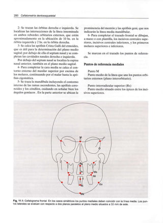 280 Cefalometría dentoesqueletal
2- Se trazan las órbitas derecha e izquierda. Se
localizan las intersecciones de la línea innominada
en ambos rebordes orbitarios externos, que están
aproximadamente en la ubicación de 10 hs. en la
órbita izquierda y 2 hs. en la órbita derecha.
3- Se calca las apófisis Crista Galli del etmoides,
que es útil para la determinación del plano medio
sagital; por debajo de ella el septum nasal y se com-
pletan las cavidades nasales derecha e izquierda.
Por debajo del septum nasal se localiza la espina
nasal anterior, también en el plano medio sagital.
4- Para completar la cara media se calca el con-
torno externo del maxilar superior por encima de
los molares, continuando por el malar hasta la apó-
fisis cigomática.
5- Se traza la mandíbula incluyendo el contorno
interno de las ramas ascendentes, las apófisis coro-
noides y los cóndilos, cuidando en señalar bien los
ángulos goníacos . En la parte anterior se ubican la
prominencia del mentón y las apófisis geni, que nos
indicarán la línea media mandibular.
6- Para completar el trazado frontal se dibujan,
a mano o con plantilla, los incisivos centrales supe-
riores, incisivos centrales inferiores, y los primeros
molares superiores e inferiores.
Se marcan en el trazado los puntos de referen-
cia.
Puntos de referencia mediales
Punto M
Punto medio de la línea que une los puntos orbi-
tarios externos (plano interorbitario).
Punto interradicularsuperior (Rs)
Punto medio situado entre los ápices de los inci-
sivos superiores.
Go
Fig. 11.1: Cefalograma frontal. En los casos simétricos los puntos mediales deben coincidir con la línea media. Los pun-
tos laterales se evalúan con respecto a dos planos paralelos al plano medio situados a 33 mm de este.
 