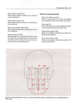 Cefalometría frontal 281
Punto incisivo superior (Is)
Punto medio superior, situado en la cresta al-
veolar interincisiva.
Punto incisivo inferior (li)
Punto medio inferior, situado en la cresta alveo-
lar interincisiva.
Punto interradicular inferior (Ri)
Punto medio situado entre los ápices de los inci-
sivos inferiores.
Punto mentoniano (Me)
Punto situado en el reborde inferior de la sínfi-
sis, debajo de la protuberancia mentoniana. Es
el punto medial de dicho borde, cuya proyec-
ción coincide con las apófisis Geni.
Puntos de referencia laterales
Punto O (orbitario externo).
Punto de intersección de la línea innominada
con el reborde externo del trazado de la órbita
Punto jugal (J)
En la intersección de la tuberosidad del maxilar
con el contorno inferoexterno del malar.
Punto molar superior (Ms)
Punta de la cúspide vestibular más saliente del
primer molar superior.
Punto molar inferior (Mi)
Punta de la cúspide vestibular más saliente del
primer molar inferior.
Fig. 11.2: Trazado cefalométrico frontal. Los planos horizontales deben ser paralelos entre sí y perpendiculares a la
línea media.
 