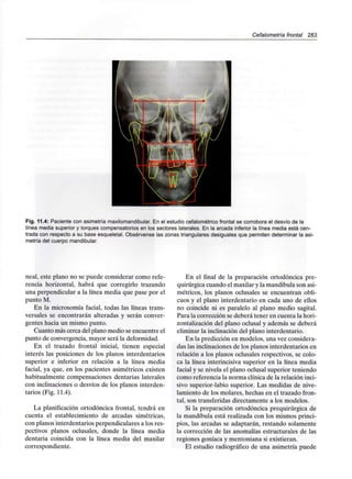 Cefalometría frontal 283
Fig. 11.4: Paciente con asimetría maxilomandibular. En el estudio cefalométrico frontal se corrobora el desvío de la
línea media superior y torques compensatorios en los sectores laterales. En la arcada inferior la línea media está cen-
trada con respecto a su base esqueletal. Obsérvense las zonas triangulares desiguales que permiten determinar la asi-
metría del cuerpo mandibular.
neal, este plano no se puede considerar como refe-
rencia horizontal, habrá que corregirlo trazando
una perpendicular a la línea media que pase por el
punto M.
En la microsomía facial, todas las líneas trans-
versales se encontrarán alteradas y serán conver-
gentes hacia un mismo punto.
Cuanto más cerca del plano medio se encuentre el
punto de convergencia,mayor será la deformidad.
En el trazado frontal inicial, tienen especial
interés las posiciones de los planos interdentarios
superior e inferior en relación a la línea media
facial, ya que, en los pacientes asimétricos existen
habitualmente compensaciones dentarias laterales
con inclinaciones o desvíos de los planos interden-
tarios (Fig. 11.4).
La planificación ortodóncica frontal, tendrá en
cuenta el establecimiento de arcadas simétricas,
con planos interdentarios perpendiculares a los res-
pectivos planos oclusales, donde la línea media
dentaria coincida con la línea media del maxilar
correspondiente.
En el final de la preparación ortodóncica pre-
quirúrgica cuando el maxilar y la mandíbula son asi-
métricos, los planos oclusales se encuentran obli-
cuos y el plano interdentario en cada uno de ellos
no coincide ni es paralelo al plano medio sagital.
Para la corrección se deberá tener en cuenta la hori-
zontalización del plano oclusal y además se deberá
eliminar la inclinación del plano interdentario.
En la predicción en modelos, una vez considera-
das las inclinaciones de los planos interdentarios en
relación a los planos oclusales respectivos, se colo-
ca la línea interincisiva superior en la línea media
facial y se nivela el plano oclusal superior teniendo
como referencia la norma clínica de la relación inci-
sivo superior-labio superior. Las medidas de nive-
lamiento de los molares, hechas en el trazado fron-
tal, son transferidas directamente a los modelos.
Si la preparación ortodóncica prequirúrgica de
la mandíbula está realizada con los mismos princi-
pios, las arcadas se adaptarán, restando solamente
la corrección de las anomalías estructurales de las
regiones goníaca y mentoniana si existieran.
El estudio radiográfico de una asimetría puede
 
