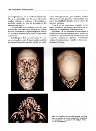 284 Cefalometría dentoesqueletal
ser complementado con la incidencia vertex-men-
tón que, adicionando otra dimensión al estudio,
ayuda a esclarecer el origen de la deformidad, en
particular cuando se trate de anomalías de las
ramas mandibulares.
La combinación de los exámenes laterales, pos-
teroanterior y vertex-mentón, permite una recons-
trucción tridimensional, importante para el estudio
de las ramas mandibulares y de las tuberosidades
del maxilar.
En la búsqueda de la verdadera causa de la asi-
metría, con el propósito de su corrección, es útil el
recurso del examen tomográfico frontal, con varios
cortes anteroposteriores, que permiten obtener
informaciones más precisas, caracterizando con
mayor exactitud la localización anteroposterior de
las zonas afectadas.
A partir de los tomogramas obtenidos en los
cortes se diseñan los respectivos trazados, que se
reúnen en un trazado final de reconstrucción.
Finalmente, la reconstrucción tridimensional a
partir del estudio tomodensitométrico, además de
permitir una visualización más esclarecedora del
esqueleto craneofacial, permite confeccionar
modelos tridimensionales, verdaderos dimensiona-
dores del problema.
Fig. 11.5: La reconstrucción tridimensional helicoidal
permite apreciar con mayor precisión las estructuras
craneofaciales, y es especialmente útil para el estu-
dio de las asimetrías.
 