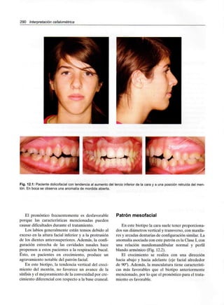 290 Interpretación cefalométrica
I
Fig. 12.1: Paciente dolicofacial con tendencia al aumentodel tercio inferior de la cara y a una posición retruída del men-
tón. En boca se observa una anomalía de mordida abierta.
El pronóstico frecuentemente es desfavorable
porque las características mencionadas pueden
causar dificultades durante el tratamiento.
Los labios generalmente están tensos debido al
exceso en la altura facial inferior y a la protrusión
de los dientes anterosuperiores. Además, la confi-
guración estrecha de las cavidades nasales hace
propensos a estos pacientes a la respiración bucal.
Ésto, en pacientes en crecimiento, produce un
agravamiento notable del patrón facial.
En este biotipo, la tendencia vertical del creci-
miento del mentón, no favorece un avance de la
sínfisis y el mejoramiento de la convexidad por cre-
cimiento diferencialcon respecto a la base craneal.
Patrón mesofacial
En este biotipo la cara suele tener proporciona-
dos sus diámetros vertical y transverso, con maxila-
res y arcadas dentarias de configuraciónsimilar. La
anomalía asociada con este patrón es la Clase I, con
una relación maxilomandibular normal y perfil
blando armónico (Fig. 12.2).
El crecimiento se realiza con una dirección
hacia abajo y hacia adelante (eje facial alrededor
de 90°). Además, la musculatura tiene característi-
cas más favorables que el biotipo anteriormente
mencionado, por lo que el pronóstico para el trata-
miento es favorable.
 