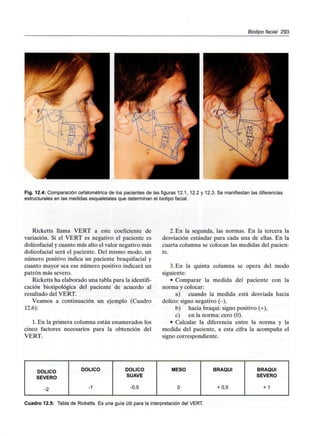 Biotipo facial 293
••2
Fig. 12.4: Comparación cefalométrica de los pacientesde las figuras 12.1, 12.2 y 12.3. Se manifiestan las diferencias
estructurales en las medidas esqueletales que determinan el biotipo facial.
Ricketts llama VERT a este coeficiente de
variación. Si el VERT es negativo el paciente es
dolicofacial y cuanto más alto el valor negativo más
dolicofacial será el paciente. Del mismo modo, un
número positivo indica un paciente braquifacial y
cuanto mayor sea ese número positivo indicará un
patrón más severo.
Ricketts ha elaborado una tabla para laidentifi-
cación biotipológica del paciente de acuerdo al
resultado del VERT.
Veamos a continuación un ejemplo (Cuadro
12.6):
1. En la primera columna están enumerados los
cinco factores necesarios para la obtención del
VERT.
2. En la segunda, las normas. En la tercera la
desviación estándar para cada una de ellas. En la
cuarta columna se colocan las medidas del pacien-
te.
3. En la quinta columna se opera del modo
siguiente:
• Comparar la medida del paciente con la
norma y colocar:
a) cuando la medida está desviada hacia
dolico: signo negativo (-),
b) hacia braqui: signo positivo (+),
c) en la norma: cero (0).
• Calcular la diferencia entre la norma y la
medida del paciente, a esta cifra la acompaña el
signo correspondiente.
DOLICO
SEVERO
-2
DOLICO
-1
DOLICO
SUAVE
-0,5
MESO
0
BRAQUI
+0,5
BRAQUI
SEVERO
+ 1
Cuadro 12.5: Tabla de Ricketts. Es una guía útil para la interpretación del VERT.
 