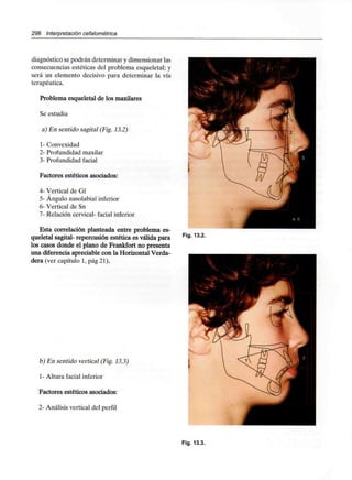 298 Interpretación cefalométríca
diagnóstico se podrán determinar y dimensionar las
consecuencias estéticas del problema esqueletal; y
será un elemento decisivo para determinar la vía
terapéutica.
Problema esqueletal de los maxilares
Se estudia
a) En sentido sagital (Fig.13.2)
1- Convexidad
2- Profundidad maxilar
3- Profundidad facial
Factores estéticos asociados:
4- Vertical de Gl
5- Ángulo nasolabial inferior
6- Vertical de Sn
7- Relación cervical- facial inferior
Esta correlación planteada entre problema es-
queletal sagital- repercusión estética es válida para
los casos donde el plano de Frankfort no presenta
una diferencia apreciable con la Horizontal Verda-
dera (ver capítulo 1, pág 21).
Fig. 13.2.
b) En sentido vertical (Fig.13.3)
1- Altura facial inferior
Factores estéticos asociados:
2- Análisis vertical del perfil
Fig. 13.3.
 
