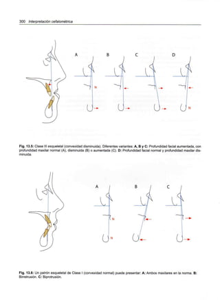 300 Interpretación cefalométrica
A , B . C
or^. 13.5:Clase III esqueletal (convexidad disminuida). Diferentes variantes: A, B y C: Profundidad facial a
profundidad maxilar normal (A), disminuida (B) o aumentada (C). D: Profundidad facial normal y profundidad maxilar dis-
minuida.
Fig. 13.6: Un patrón esqueletal de Clase I (convexidad normal) puede presentar: A: Ambos maxilares en la norma. B:
Birretrusión. C: Biprotrusión.
 