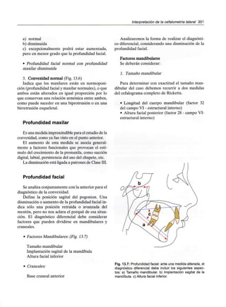 Interpretación de la cefalometría lateral 301
a) normal
b) disminuida
c) excepcionalmente podrá estar aumentada,
pero en menor grado que la profundidad facial.
• Profundidad facial normal con profundidad
maxilar disminuida
3. Convexidad normal (Fig. 13.6)
Indica que los maxilares están en normoposi-
ción (profundidad facial y maxilar normales), o que
ambos están alterados en igual proporción por lo
que conservan una relación armónica entre ambos,
como puede suceder en una biprotrusión o en una
birretrusión esqueletal.
Profundidad maxilar
Es una medida imprescindible para el estudio de la
convexidad, como ya fue visto en el punto anterior.
El aumento de esta medida se asocia general-
mente a factores funcionales que provocan el estí-
mulo del crecimiento de la premaxila,como succión
digital, labial, persistencia del uso del chupete, etc.
La disminución está ligada a patrones de Clase III.
Profundidad facial
Se analiza conjuntamente con la anterior para el
diagnóstico de la convexidad.
Define la posición sagital del pogonion. Una
disminución o aumento de la profundidad facial in-
dica sólo una posición retruida o avanzada del
mentón, pero no nos aclara el porqué de esa situa-
ción. El diagnóstico diferencial debe considerar
factores que pueden dividirse en mandibulares y
craneales.
• Factores Mandibulares: (Fig. 13.7)
Tamaño mandibular
Implantación sagital de la mandíbula
Altura facial inferior
• Craneales:
Base craneal anterior
Analizaremos la forma de realizar el diagnósti-
co diferencial, considerando una disminución de la
profundidad facial.
Factores mandibulares
Se deberán considerar:
1. Tamaño mandibular
Para determinar con exactitud el tamaño man-
dibular del caso debemos recurrir a dos medidas
del cefalograma completo de Ricketts.
• Longitud del cuerpo mandibular (factor 32
del campo VI - estructural interno)
• Altura facial posterior (factor 28 - campo VI-
estructural interno)
Fig. 13.7: Profundidad facial: ante una medida alterada, el
diagnóstico diferencial debe incluir los siguientes aspec-
tos: a) Tamaño mandibular, b) Implantación sagital de la
mandíbula, c) Altura facial inferior.
 