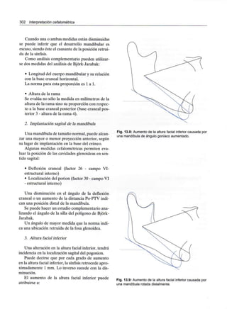 302 Interpretación cefalométrica
Cuando una o ambas medidas están disminuidas
se puede inferir que el desarrollo mandibular es
escaso, siendo éste el causante de la posición retrui-
da de la sínfisis.
Como análisis complementario pueden utilizar-
se dos medidas del análisis de Bjórk-Jarabak:
• Longitud del cuerpo mandibular y su relación
con la base craneal horizontal.
La norma para esta proporción es 1 a 1.
• Altura de la rama
Se evalúa no sólo la medida en milímetros de la
altura de la rama sino su proporción con respec-
to a la base craneal posterior (base craneal pos-
terior 3 - altura de la rama 4).
2. Implantación sagital de la mandíbula
Una mandíbula de tamaño normal, puede alcan-
zar una mayor o menor proyección anterior, según
su lugar de implantación en la base del cráneo.
Algunas medidas cefalométricas permiten eva-
luar la posición de las cavidades glenoideas en sen-
tido sagital:
• Deflexión craneal (factor 26 - campo VI-
estructural interno)
• Localización del porion (factor 30 - campo VI
• estructural interno)
Una disminución en el ángulo de la deflexión
craneal o un aumento de la distancia Po-PTV indi-
can una posición distal de la mandíbula.
Se puede hacer un estudio complementario ana-
lizando el ángulo de la silla del polígono de Bjórk-
Jarabak.
Un ángulo de mayor medida que la norma indi-
ca una ubicación retruida de la fosa glenoidea.
3. Altura facial inferior
Una alteración en la altura facial inferior, tendrá
incidencia en la localización sagital del pogonion.
Puede decirse que por cada grado de aumento
en la altura facial inferior, la sínfisis retrocede apro-
ximadamente 1 mm. Lo inverso sucede con la dis-
minución.
El aumento de la altura facial inferior puede
atribuirse a:
Fig. 13.8: Aumento de la altura facial inferior causada por
una mandíbula de ángulo goníaco aumentado.
Fig. 13.9: Aumento de la altura facial inferior causada por
una mandíbula rotada distalmente.
 