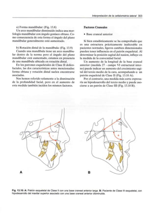 Interpretación de la cefalometría lateral 303
a) Forma mandibular: (Fig. 13.8)
Un arco mandibular disminuido indica una mor-
fología mandibular con ángulo goníaco obtuso. Co-
mo consecuencia de esta forma el ángulo del plano
mandibular generalmente está aumentado.
b) Rotación distal de la mandíbula: (Fig. 13.9)
Cuando una mandíbula tiene un arco mandibu-
lar dentro de la norma pero el ángulo del plano
mandibular está aumentado, estamos en presencia
de una mandíbula ubicada en rotación distal.
En los patrones esqueletales de Clase II dolico-
faciales, las dos características antes mencionadas:
forma obtusa y rotación distal suelen encontrarse
asociadas.
Nos hemos referido solamente a la disminución
de la profundidad facial, pero en el aumento de
esta medida también inciden los mismos factores.
Factores Craneales
• Base craneal anterior
Si bien estadísticamente se ha comprobado que
es una estructura prácticamente inalterable en
pacientes normales, ligeros cambios dimensionales
pueden tener influencia en el patrón esqueletal. Al
determinar la posición sagital del nasion, influye en
la medida de la convexidad facial.
Un aumento de la longitud de la base craneal
anterior (medida 27 - campo VI estructural inter-
no) puede indicar un aumento del crecimiento sagi-
tal del tercio medio de la cara, acompañando a un
patrón esqueletal de Clase II (Fig. 13.10 A).
Por el contrario, una medida más corta expresa-
ría un hipodesarrollo del tercio medio y puede aso-
ciarse a un patrón de Clase III (Fig. 13.10 B).
B
Fig. 13.10: A: Patrón esqueletal de Clase II con una base craneal anterior larga. B: Paciente de Clase III esqueletal, con
hipodesarrollo del maxilar superior asociado con una base craneal anterior disminuida.
 