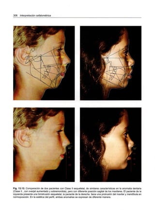 306 Interpretación cefalométrica
Fig. 13.13: Comparación de dos pacientes con Clase II esqueletal, de similares características en la anomalía dentaria
(Clase II , con overjet aumentado y sobremordida), pero con diferente posición sagital de los maxilares. El paciente de la
izquierda presenta una birretrusión esqueletal, la paciente de la derecha tiene una protrusión del maxilar y mandíbula en
normoposición. En la estética del perfil, ambas anomalías se expresan de diferente manera.
 
