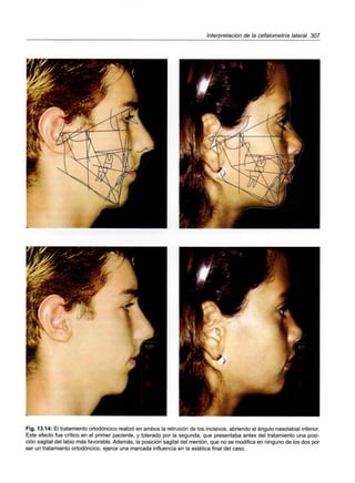 Interpretación de la cefalometrla lateral 307
Fig. 13.14: El tratamiento ortodóncico realizó en ambos la retrusión de los incisivos, abriendo el ángulo nasolabial inferior.
Este efecto fue crítico en el primer paciente, y tolerado por la segunda, que presentaba antes del tratamiento una posi-
ción sagital del labio más favorable. Además, la posición sagital del mentón, que no se modifica en ninguno de los dos por
ser un tratamiento ortodóncico, ejerce una marcada influencia en la estética final del caso.
 