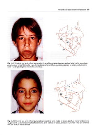 Interpretación de la cefalometría lateral 309
Fig. 13.17: Paciente con tercio inferior aumentado. En la cefalometría se observa una altura facial inferior aumentada,
por un exceso vertical del maxilar y una forma obtusa de la mandíbula, que se expresa por un arco mandibular dismi-
nuido y un ángulo de plano mandibular aumentado.
Fig. 13.18: Paciente con tercio inferior aumentado en relación al tercio medio de la cara. La altura maxilar está disminui-
da, generando un aumento de la altura facial inferior. En la estética de la cara, se observa una nariz corta que tiene rela-
ción con la altura maxilar escasa.
 
