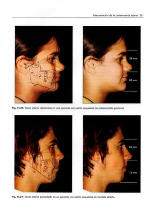 Interpretación de la cefalometría lateral 311
Fig. 13.20: Tercio inferior disminuido en una paciente con patrón esqueletal de sobremordida profunda.
Fig. 13.21: Tercio inferior aumentado en un paciente con patrón esqueletal de mordida abierta.
 