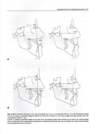 Interpretación de la cefalometría lateral 313
O
B
Fig. 13.23: A: Paciente de Clase III con una convexidad de -2 mm, y una distancia A-B de -7 mm. B: Paciente de Clase
III, con una mayor convexidad negativa debido a la forma de la sínfisis y a una mayor longitud de base craneal, pero con
una distancia A-B de -1 mm.
Si bien un análisis superficial basado en el valor de la convexidad podría hacer pensar que el caso A es más favorable
para un tratamiento de compensación ortodóncica, la distancia A-B revela que, por el contrario es mucho menos factible
la compensación que en el caso B.
 