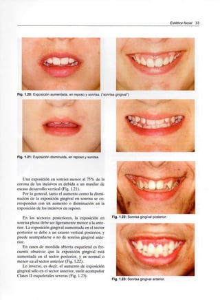 Estética facial 33
Fig. 1.20: Exposiciónaumentada,en reposo y sonrisa, ("sonrisa gingival")
I
Fig. 1.21: Exposición disminuida, en reposo y sonrisa.
Una exposición en sonrisa menor al 75% de la
corona de los incisivos es debida a un maxilar de
escaso desarrollo vertical (Fig. 1.21).
Por lo general, tanto el aumento como la dismi-
nución de la exposición gingival en sonrisa se co-
rresponden con un aumento o disminución en la
exposición de los incisivos en reposo.
En los sectores posteriores, la exposición en
sonrisa plena debe ser ligeramente menor a la ante-
rior. La exposición gingival aumentada en el sector
posterior se debe a un exceso vertical posterior, y
puede acompañarse o no de sonrisa gingival ante-
rior.
En casos de mordida abierta esqueletal es fre-
cuente observar que la exposición gingival está
aumentada en el sector posterior, y es normal o
menor en el sector anterior (Fig. 1.22).
Lo inverso, es decir, el aumento de exposición
gingival sólo en el sector anterior, suele acompañar
Clases II esqueletales severas (Fig. 1.23).
Fig. 1.22: Sonrisa gingival posterior.
Fig. 1.23: Sonrisa gingivalanterior.
 