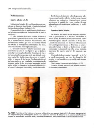 314 Interpretación cefalométrica
Problema dentario
Incisivo inferior a A-Po
Iniciamos el estudio del problema dentario, mi-
diendo la distancia lineal desde el borde incisal del
incisivo inferior hasta el plano A-Po.
Esta medida define la posición sagital de la arca-
da inferior con respecto al límite anterior de ambos
maxilares.
El valor obtenido determina cuántos milímetros
por delante o por detrás del plano A-Po está ubica-
da la arcada dentaria inferior. Relacionando esta
medida con la norma (que tiene un valor de +lmm)
se obtiene la discrepancia cefalométrica del caso,
dato fundamental para la planificación .
La posición del incisivo inferior en sentido ante-
roposterior es uno de los objetivos que se definen
con el proceso de planificación. Constituye la clave
de la estética labial, porque es la que dicta la posi-
ción sagital del incisivo superior, y éste es en defi-
nitiva el soporte de los labios. En el estudio inicial
del caso, deberán ser estudiadas y relacionadas la
posición sagital de los incisivos y la posición sagital
de los labios, evaluando la medida del labio inferior
al plano E, el ángulo nasolabial y el contacto labial.
Por lo tanto, la decisión sobre la posición ade-
cuada para el incisivo inferior no debe estar basada
solamente en parámetros cefalométricos, porque
no siempre la medida de +lmm resultará la más
adecuada para la estética de los labios y el perfil.
(Fig. 13.24)
Overjet o resalte incisivo
La medida del resalte es de muy fácil aprecia-
ción, ya que consiste en la distancia lineal entre el
borde incisal de ambos incisivos medida en forma
paralela al plano oclusal. La norma es de 2,5 mm.
Cuando se relacionan los incisivos inferiores con
sus homólogos superiores, se determina la natura-
leza del overjet, es decir, se define si un overjet
aumentado o disminuido se debe a una posición
incorrecta del incisivo inferior, del superior o de
ambos.
Partiendo de la norma de -i-lmm del 1 al A-Po,
se puede comprender en caso de alteración del
overjet, en qué medida es responsable cada uno de
los incisivos.
Observemos los ejemplos de la figura 12.25.
Los tres dibujos muestran un overjet anormal,
en este caso, aumentado.
Fig. 13.24: Pacientes con los incisivos en la norma cefalométrica con respecto al plano A-Po. En A, por lascaracterísti-
cas braquifaciales y del perfil se podría recurrir a una protrusión mayor. En B, al tratarse de un paciente dolicofacial, con
un perfil en el límite de la protrusión labial y con cierre labial forzado, está contraindicado un avance de los incisivos.
 
