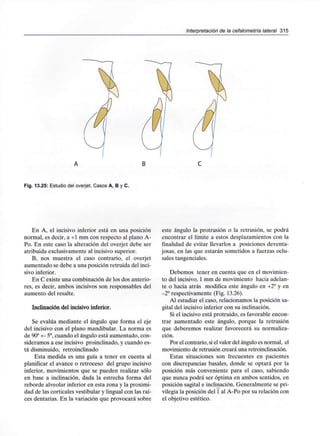 Interpretación de la cefalometría lateral 315
Fig. 13.25: Estudio del overjet. Casos A, B y C.
En A, el incisivo inferior está en una posición
normal, es decir, a +1 mm con respecto al plano A-
Po. En este caso la alteración del overjet debe ser
atribuida exclusivamente al incisivo superior.
B, nos muestra el caso contrario, el overjet
aumentado se debe a una posición retruida del inci-
sivo inferior.
En C existe una combinación de los dos anterio-
res, es decir, ambos incisivos son responsables del
aumento del resalte.
Inclinación del incisivo inferior.
Se evalúa mediante el ángulo que forma el eje
del incisivo con el plano mandibular. La norma es
de 90a +- 5°,cuando el ángulo está aumentado, con-
sideramos a ese incisivo proinclinado, y cuando es-
tá disminuido, retroinclinado
Esta medida es una guía a tener en cuenta al
planificar el avance o retroceso del grupo incisivo
inferior, movimientos que se pueden realizar sólo
en base a inclinación, dada la estrecha forma del
reborde alveolar inferior en esta zona y la proximi-
dad de las corticales vestibular y lingual con las raí-
ces dentarias. En la variación que provocará sobre
este ángulo la protrusión o la retrusión, se podrá
encontrar el límite a estos desplazamientos con la
finalidad de evitar llevarlos a posiciones deventa-
josas, en las que estarán sometidos a fuerzas oclu-
sales tangenciales.
Debemos tener en cuenta que en el movimien-
to del incisivo, 1 mm de movimiento hacia adelan-
te o hacia atrás modifica este ángulo en +2° y en
-2° respectivamente (Fig. 13.26).
Al estudiar el caso, relacionamos la posición sa-
gital del incisivo inferior con su inclinación.
Si el incisivo está protruido, es favorable encon-
trar aumentado este ángulo, porque la retrusión
que deberemos realizar favorecerá su normaliza-
ción.
Por el contrario, si el valor del ánguloes normal, el
movimiento de retrusión creará una retroinclinación.
Estas situaciones son frecuentes en pacientes
con discrepancias básales, donde se optará por la
posición más conveniente para el caso, sabiendo
que nunca podrá ser óptima en ambos sentidos, en
posición sagital e inclinación. Generalmente se pri-
vilegia la posición del 1 al A-Po por su relación con
el objetivo estético.
 