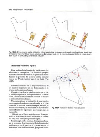 316 Interpretación cefalométrica
Fig. 13.26: El movimiento sagital del incisivo inferior se planifica sin torque, por lo que la modificación del ángulo que
forma con el plano mandibular puede calcularse en 2 grados por cada mm de movimiento sagital del borde incisal, abrien-
do el ángulo la protrusión y cerrándolo la retrusión.
Inclinación del incisivo superior
Para analizar la inclinación del incisivo superior
adoptamos el concepto de J. M. Damerell quepro-
pone utilizar como referencia al eje facial e indivi-
dualizar la posición del incisivo central superior
con su eje 5° más vertical que el eje facial (Fig.
13.27).
Esto es coincidente con la mayor verticalidadde
los incisivos superiores en los dolicofaciales y lo
inverso en los patrones braqui.
Cuando es paralelo, o más horizontal que eleje,
el incisivo superior se halla proinclinado. A la in-
versa, cuando se encuentra más vertical, el incisivo
se encuentra retroinclinado.
Una vez evaluada la inclinación de este incisivo
con respecto al parámetro mencionado, se la rela-
ciona con su posición en sentido sagital, es decir, la
medida del overjet y la necesidad de movimiento
en sentido anterior o posterior que requiera para su
corrección.
Al igual que el factor anteriormente descripto,
indica si la inclinación actual del incisivo es favora-
ble o no para corregir su posición sagital.
Sin embargo, en los casos de discrepancias bása-
les, la necesidad de comprometer la inclinación del
incisivo superior al corregir su posición sagital es
menor que en el incisivo inferior, porque en elsec-
Fig. 13.27: Inclinación ideal del incisivo superior
 