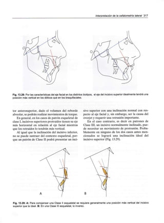 Interpretación de la cefalometría lateral 317
Fig. 13.28: Por las características del eje facial en los distintos biotipos, el eje del incisivo superior idealmente tendrá una
posición más vertical en los dólicos que en los braquifaciales.
tor anterosuperior, dado el volumen del reborde
alveolar, se podrán realizar movimientos de torque.
En general, en los casos de patrón esqueletal de
clase I, incisivos superiores protruidos tienen su eje
más horizontal en relación al eje facial mientras
que los retruidos lo tendrán más vertical.
Al igual que la inclinación del incisivo inferior,
no se puede sustraer del contexto esqueletal, por-
que un patrón de Clase II podrá presentar un inci-
sivo superior con una inclinación normal con res-
pecto al eje facial y, sin embargo, ser la causa del
overjet y requerir una retrusión importante.
En el caso contrario, es decir en patrones de
Clase III, un incisivo normalmente inclinado, pue-
de necesitar un movimiento de protrusión. Proba-
blemente en ninguno de los dos casos antes men-
cionados se logrará una inclinación ideal del
incisivo superior (Fig. 13.29).
B
Fig. 13.29: A: Para compensar una Clase II esqueletal se requiere generalmente una posición más vertical del incisivo
superior que la ideal. B: En una Clase III esqueletal, lo inverso.
 