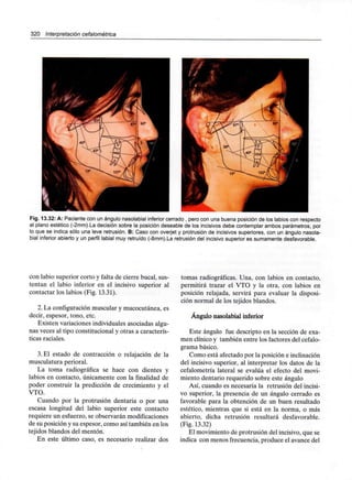 320 Interpretación cefalométrica
Fig. 13.32: A: Paciente con un ángulo nasolabial inferior cerrado , pero con una buena posición de los labios con respecto
al plano estético (-2mm).La decisión sobre la posición deseable de los incisivos debe contemplar ambos parámetros, por
lo que se indica sólo una leve retrusión. B: Caso con overjet y protrusión de incisivos superiores, con un ángulo nasola-
bial inferior abierto y un perfil labial muy retruído (-8mm).La retrusión del incisivo superior es sumamente desfavorable.
con labio superior corto y falta de cierre bucal, sus-
tentan el labio inferior en el incisivo superior al
contactar los labios (Fig. 13.31).
2. La configuración muscular y mucocutánea, es
decir, espesor, tono, etc.
Existen variaciones individualesasociadas algu-
nas veces al tipo constitucional y otras a caracterís-
ticas raciales.
3. El estado de contracción o relajación de la
musculatura perioral.
La toma radiográfica se hace con dientes y
labios en contacto, únicamente con la finalidad de
poder construir la predicción de crecimiento y el
VTO.
Cuando por la protrusión dentaria o por una
escasa longitud del labio superior este contacto
requiere un esfuerzo, se observarán modificaciones
de su posición y su espesor, como así también en los
tejidos blandos del mentón.
En este último caso, es necesario realizar dos
tomas radiográficas. Una, con labios en contacto,
permitirá trazar el VTO y la otra, con labios en
posición relajada, servirá para evaluar la disposi-
ción normal de los tejidos blandos.
Ángulo nasolabial inferior
Este ángulo fue descripto en la sección de exa-
men clínico y también entre los factores del cefalo-
grama básico.
Como está afectado por la posición e inclinación
del incisivo superior, al interpretar los datos de la
cefalometría lateral se evalúa el efecto del movi-
miento dentario requerido sobre este ángulo
Así, cuando es necesaria la retrusión del incisi-
vo superior, la presencia de un ángulo cerrado es
favorable para la obtención de un buen resultado
estético, mientras que si está en la norma, o más
abierto, dicha retrusión resultará desfavorable.
(Fig. 13.32)
El movimiento de protrusión del incisivo, que se
indica con menos frecuencia, produce el avance del
 