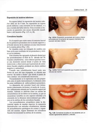 Estética facial 35
Exposición de incisivos inferiores
En reposo labial, la exposición del incisivo infe-
rior debe ser de O mm. Su exposición en reposo
puede deberse a una extrusión de los mismos, o a
una eversión del labio inferior. Esta eversión es fre-
cuente en pacientes con escaso desarrollo mandi-
bular o del mentón (Fig. 1.25 A y B).
Corredores bucales
Es el espacio que existe entre el contorno lateral
de los primeros premolares de la arcada superior y
el borde interno de la comisura en una vista frontal
de la sonrisa plena (Fig. 1.26).
Se visualiza como un triángulo de sombra con
base en la cara vestibular de los premolares y vérti-
ce en la comisura.
Este término fue agregado al glosario dental por
los prostodoncistas al final de la década del 50.
Cuando rehabilitaban, estos clínicos querían recre-
ar una dentición natural desde el punto de vista
transversal, y observaron que la presencia de corre-
dores bucales amplios producía un efecto estético
negativo y antinatural.
Cuando una rehabilitación bucal tenía una
forma de arco del tipo triangular, se obtenía una
sonrisa "de molar a molar" que desde el punto de
vista estético era consideradaincorrecta.
Frecuentemente se lo representa con una propor-
ción entre el ancho intercomisural y la distancia entre
las caras vestibulares de ambos primeros premolares.
La dimensión del corredor bucal está íntima-
mente relacionada a la forma y el ancho de la arca-
da e influenciada además por la posición sagital del
maxilar. Además se deberán tener en cuenta las
características de los labios en la sonrisa, ya que se
encuentran variables en este aspecto referidas a la
extensión de la distancia intercomisural que influ-
yen en la estética de los corredores bucales.
Los procedimientos ortopédicos como la dis-
yunción rápida de maxilar superior, la expansión
dentoalveolar con métodos ortodóncicos, además
de procedimientos quirúrgicos de avance y expan-
sión del maxilar, logran disminuir los corredores
bucales favoreciendo la estética de la sonrisa.
Fig. 1.25 A: Exposición aumentadadel incisivoinferior
provocada por el aumentodel espacio interlabialy la
eversión del labio inferior.
Fig. 1.25 B: Perfil de la paciente que muestra la posición
retruida del mentón.
Fig. 1.26: Corredores bucales en una paciente con un
maxilar ligeramente estrecho y retruido.
 