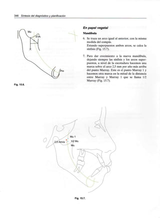 346 Síntesis del diagnóstico y planificación
En papel vegetal
Mandíbula
6. Se traza un arco igual al anterior, con la misma
medida del compás.
Estando superpuestos ambos arcos, se calca la
sínfisis (Fig. 15.7).
7. Para dar crecimiento a la nueva mandíbula,
dejando siempre las sínfisis y los arcos super-
puestos, a nivel de la escotadura hacemos una
marca sobre el arco 2,5 mm por año más arriba
del punto Murray. Este es el punto Murray 1 y
hacemos otra marca en la mitad de la distancia
entre Murray y Murray 1 que se llama 1/2
Murray (Fig. 15.7).
Fig. 15.6.
Fig. 15.7.
 