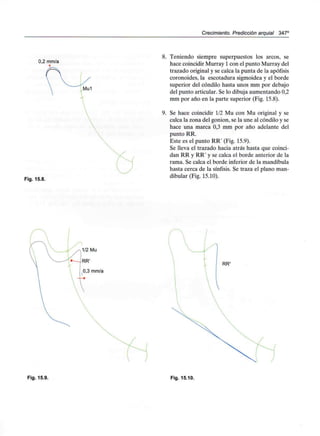 Crecimiento. Predicción arquial 347°
0,2 mm/a
Fig. 15.8.
8. Teniendo siempre superpuestos los arcos, se
hace coincidir Murray 1con el punto Murray del
trazado original y se calca la punta de la apófisis
coronoides, la escotadura sigmoidea y el borde
superior del cóndilo hasta unos mm por debajo
del punto articular. Se lo dibuja aumentando 0,2
mm por año en la parte superior (Fig. 15.8).
9. Se hace coincidir 1/2 Mu con Mu original y se
calca la zona del gonion, se la une al cóndilo y se
hace una marca 0,3 mm por año adelante del
punto RR.
Este es el punto RR' (Fig. 15.9).
Se lleva el trazado hacia atrás hasta que coinci-
dan RR y RR' y se calca el borde anterior de la
rama. Se calca el borde inferior de la mandíbula
hasta cerca de la sínfisis. Se traza el plano man-
dibular (Fig. 15.10).
Fig. 15.9. Fig. 15.10.
 