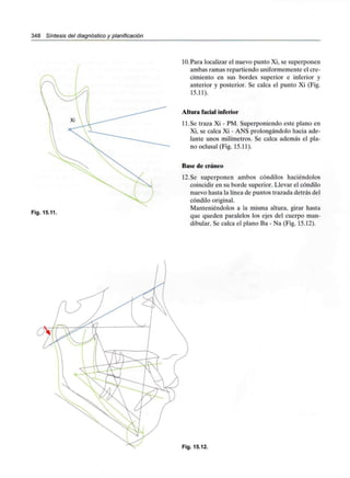 348 Síntesis del diagnóstico y planificación
Fig. 15.11.
10.Para localizar el nuevo punto Xi, se superponen
ambas ramas repartiendo uniformemente el cre-
cimiento en sus bordes superior e inferior y
anterior y posterior. Se calca el punto Xi (Fig.
15.11).
Altura facial inferior
11.Se traza Xi - PM. Superponiendo este plano en
Xi, se calca Xi - ANS prolongándolo hacia ade-
lante unos milímetros. Se calca además el pla-
no oclusal (Fig. 15.11).
Base de cráneo
12.Se superponen ambos cóndilos haciéndolos
coincidir en su borde superior. Llevar el cóndilo
nuevo hasta la línea de puntos trazada detrás del
cóndilo original.
Manteniéndolos a la misma altura, girar hasta
que queden paralelos los ejes del cuerpo man-
dibular. Se calca el plano Ba - Na (Fig. 15.12).
Fig. 15.12.
 
