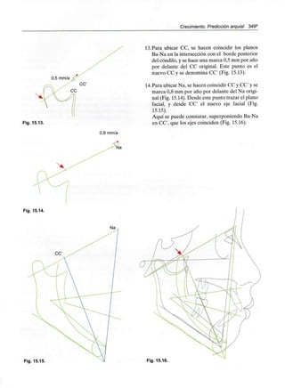 Crecimiento. Predicción arquial 349°
0,5 mm/a 4f
CC'
Fig. 15.13.
Fig. 15.14.
0,8 mm/a
13.Para ubicar CC, se hacen coincidir los planos
Ba-Na en la intersección con el borde posterior
del cóndilo, y se hace una marca 0,5 mm por año
por delante del CC original. Este punto es el
nuevo CC y se denomina CC' (Fig. 15.13).
14.Para ubicar Na, se hacen coincidir CC y CC' y se
marca 0,8 mm por año por delante del Na origi-
nal (Fig. 15.14). Desde este punto trazar el plano
facial, y desde CC' el nuevo eje facial (Fig.
15.15).
Aquí se puede constatar, superponiendo Ba-Na
en CC', que los ejes coinciden (Fig. 15.16).
Fig. 15.15. Fig. 15.16.
 
