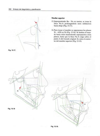 350 Síntesis del diagnóstico y planificación
Fig. 15.17.
Maxilar superior
15. Superponiendo Ba - Na en nasion, se traza la
línea Na-A prolongándola unos milímetros
hacia abajo (Fig. 15.17).
16.Para trazar el maxilar se superponen los planos
Xi - ANS en Xi (Fig. 15.18). Se desliza el traza-
do hacia atrás manteniendo superpuestos estos
planos, hasta que la línea Na-A caiga sobre el
punto A del trazado original. Se calca el contor-
no del maxilar superior (Fig. 15.19).
Fig. 15.18
Fig. 15.19.
 