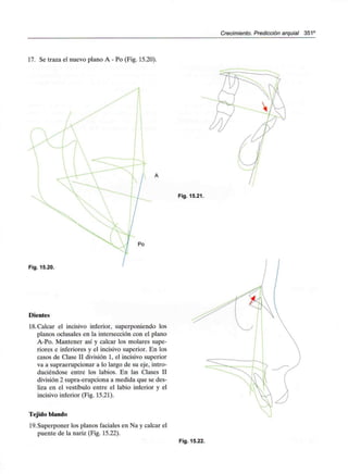 Crecimiento. Predicción arquial 351C
17. Se traza el nuevo plano A - Po (Fig. 15.20).
Fig. 15.21.
Po
Fig. 15.20.
Dientes
18.Calcar el incisivo inferior, superponiendo los
planos oclusales en la intersección con el plano
A-Po. Mantener así y calcar los molares supe-
riores e inferiores y el incisivo superior. En los
casos de Clase II división 1, el incisivo superior
va a supraerupcionar a lo largo de su eje, intro-
duciéndose entre los labios. En las Clases II
división 2 supra-erupciona a medida que se des-
liza en el vestíbulo entre el labio inferior y el
incisivo inferior (Fig. 15.21).
Tejido blando
19. Superponer los planos faciales en Na y calcar el
puente de la nariz (Fig. 15.22).
Fig. 15.22.
 