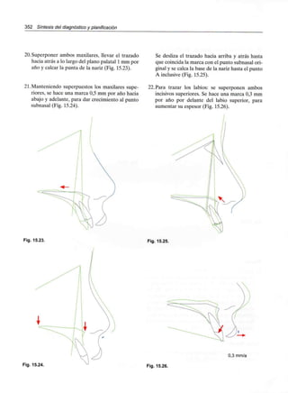 352 Síntesis del diagnóstico y planificación
20.Superponer ambos maxilares, llevar el trazado
hacia atrás a lo largo del plano palatal 1mm por
año y calcar la punta de la nariz (Fig. 15.23).
21.Manteniendo superpuestos los maxilares supe-
riores, se hace una marca 0,5 mm por año hacia
abajo y adelante, para dar crecimiento al punto
subnasal (Fig. 15.24).
Se desliza el trazado hacia arriba y atrás hasta
que coincida la marca con el punto subnasal ori-
ginal y se calca la base de la nariz hasta el punto
A inclusive (Fig. 15.25).
22.Para trazar los labios: se superponen ambos
incisivos superiores. Se hace una marca 0,3 mm
por año por delante del labio superior, para
aumentar su espesor (Fig. 15.26).
Fig. 15.23. Fig. 15.25.
Fig. 15.24
0,3 mm/a
Fig. 15.26.
 
