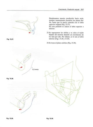 Crecimiento. Predicción arquial 353°
Fig. 15.27.
Desplazamos nuestra predicción hacia atrás,
siempre manteniendo paralelos los planos Ba-
Na, hasta que la marca coincida con el labio
superior original (Fig. 15.27).
En esta posición se calcan el labio superior e
inferior.
23.Se superponen las sínfisis y se calca el tejido
blando del mentón dándole un crecimiento de
0,3 mm por año. Por último, se lo une al labio
inferior (Figs. 15.28 y 15.29).
24.Se traza el plano estético (Fig. 15.30).
Fig. 15.28.
Fig. 15.29. Fig. 15.30.
 
