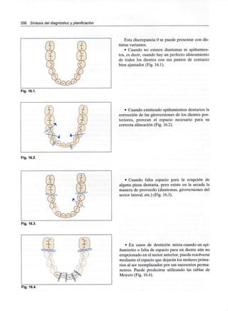 356 Síntesis del diagnóstico y planificación
Fig. 16.1.
Fig. 16.2.
Esta discrepancia Ose puede presentar con dis-
tintas variantes.
• Cuando no existen diastemas ni apiñamien-
tos, es decir, cuando hay un perfecto alineamiento
de todos los dientes con sus puntos de contacto
bien ajustados (Fig. 16.1).
• Cuando existiendo apiñamientos dentarios la
corrección de las giroversiones de los dientes pos-
teriores, provean el espacio necesario para su
correcta alineación (Fig. 16.2).
• Cuando falta espacio para la erupción de
alguna pieza dentaria, pero existe en la arcada la
manera de proveerlo (diastemas, giroversiones del
sector lateral, etc.) (Fig. 16.3).
Fig. 16.3.
• En casos de dentición mixta cuando un api-
ñamiento o falta de espacio para un diente aún no
erupcionado en el sector anterior, pueda resolverse
mediante el espacio que dejarán los molares prima-
rios al ser reemplazados por sus sucesorios perma-
nentes. Puede predecirse utilizando las tablas de
Moyers (Fig. 16.4).
Fig. 16.4.
 